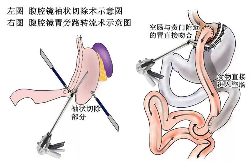 耳夹的原理及其应用，一种深入了解与探讨